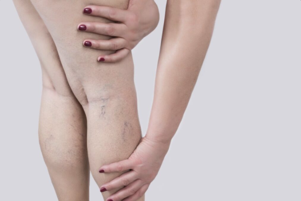 Se noti questo piccolissimo segno sulle gambe potresti avere un problema ai reni senza saperlo