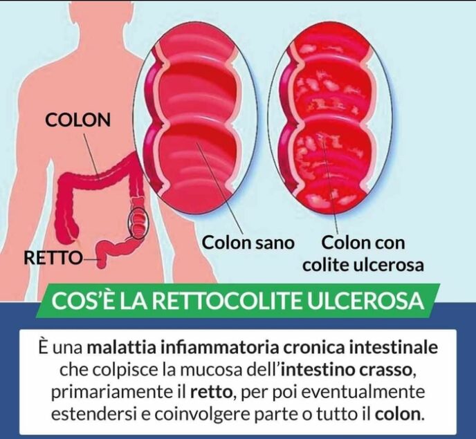 Malattie Infiammatorie Croniche Intestinali In Campania: Nuove Cure Per ...