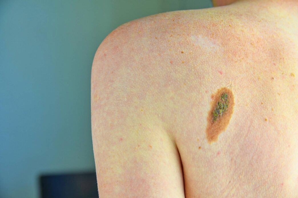 Aumentano i casi di melanoma3A